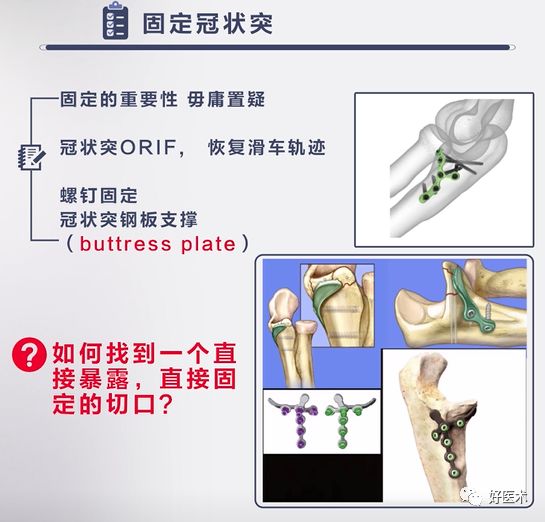 肘关节骨折脱位，我们该如何正确诊治​？