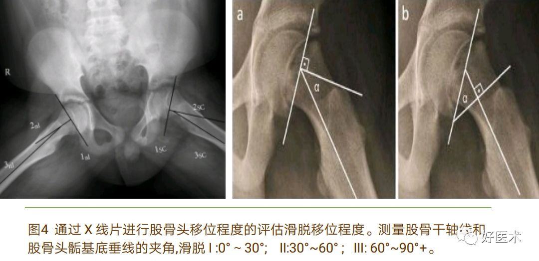 股骨头骨骺滑脱十大要点详解，帮你彻底整明白！