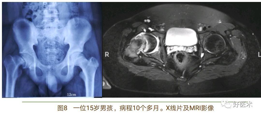 股骨头骨骺滑脱十大要点详解，帮你彻底整明白！