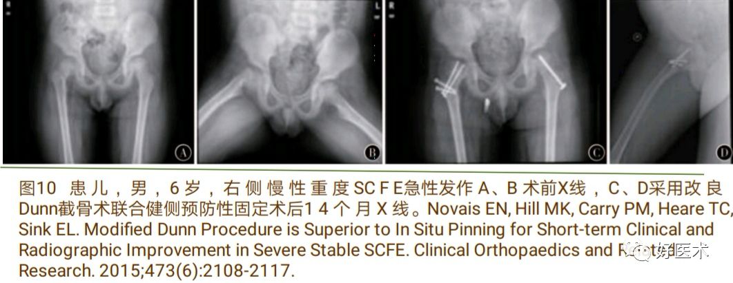 股骨头骨骺滑脱十大要点详解，帮你彻底整明白！