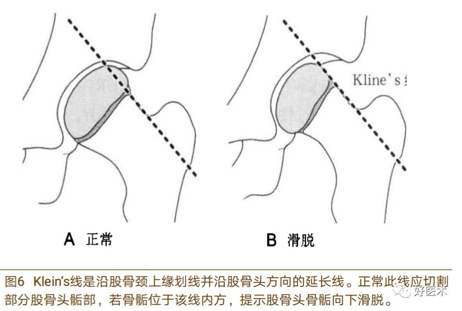 股骨头骨骺滑脱十大要点详解，帮你彻底整明白！