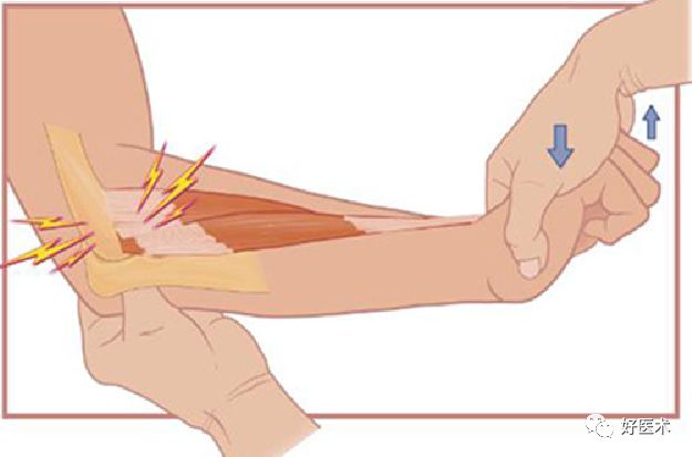 遇到网球肘该咋整？看完这篇轻松应对！