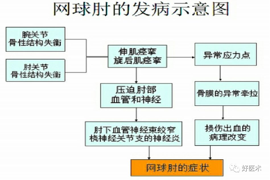 遇到网球肘该咋整？看完这篇轻松应对！