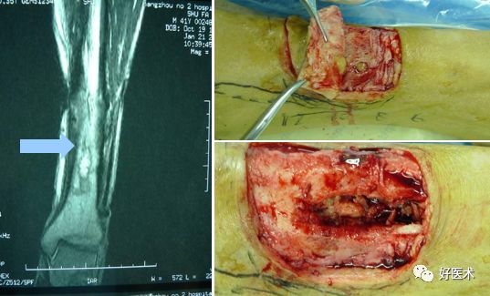 感染性骨不连治疗很棘手？看完这篇轻松搞定！