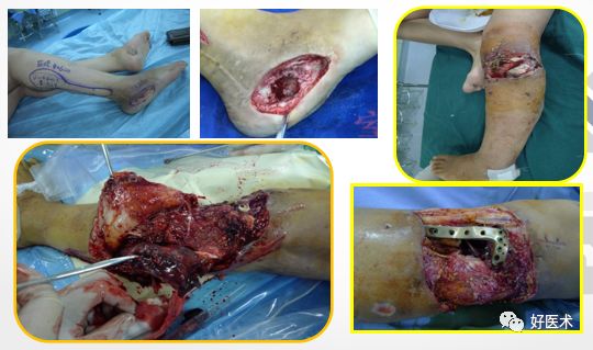 感染性骨不连治疗很棘手？看完这篇轻松搞定！