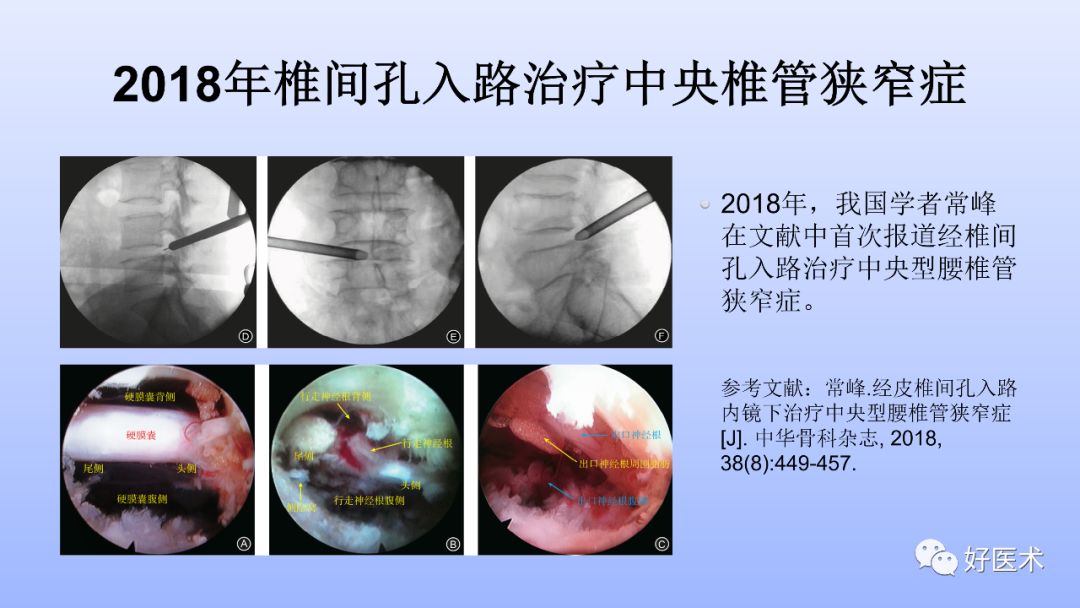 一文带您深度了解：腰椎管狭窄症！