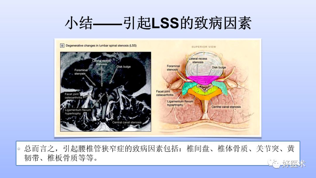 一文带您深度了解：腰椎管狭窄症！