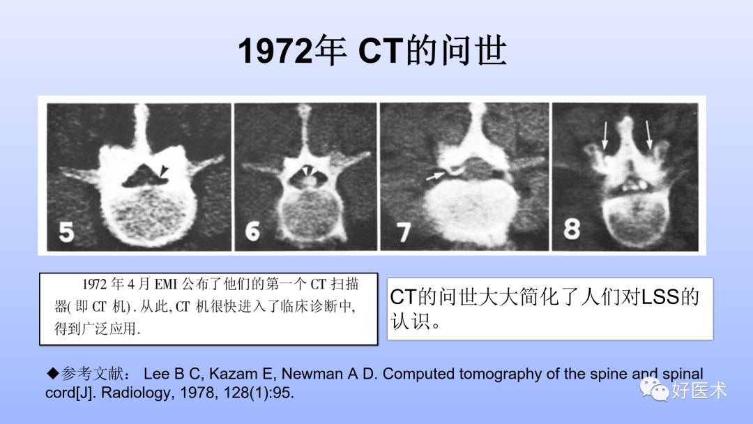 一文带您深度了解：腰椎管狭窄症！