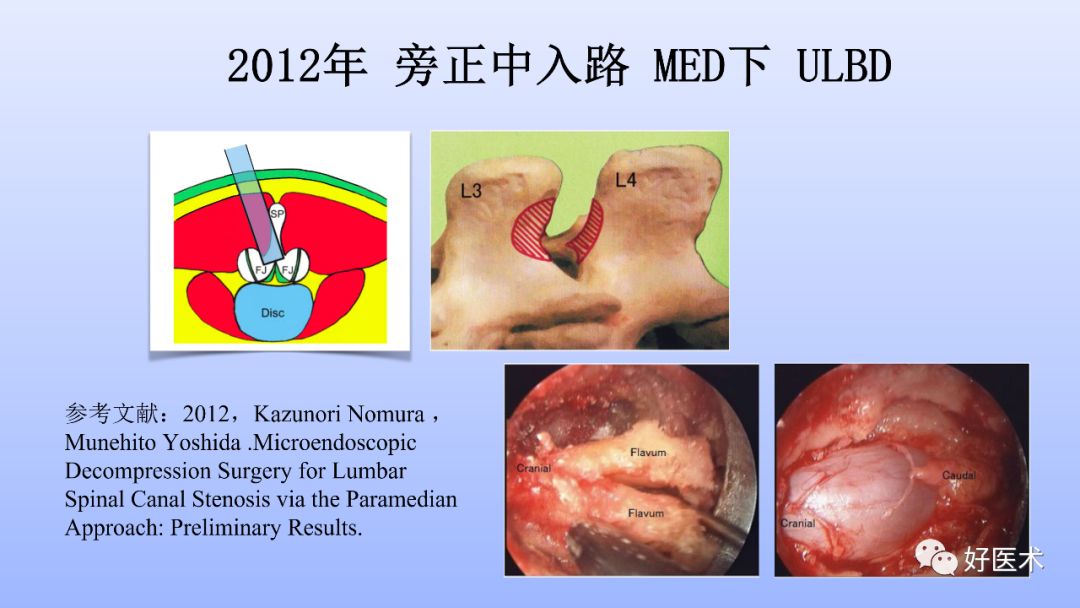 一文带您深度了解：腰椎管狭窄症！