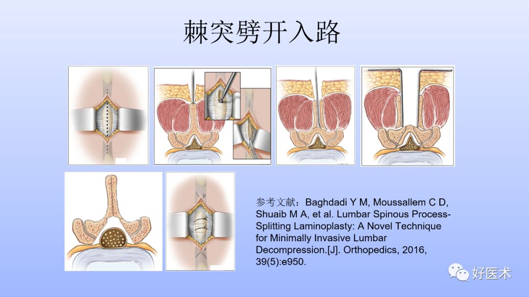 一文带您深度了解：腰椎管狭窄症！