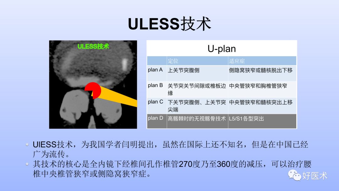 一文带您深度了解：腰椎管狭窄症！