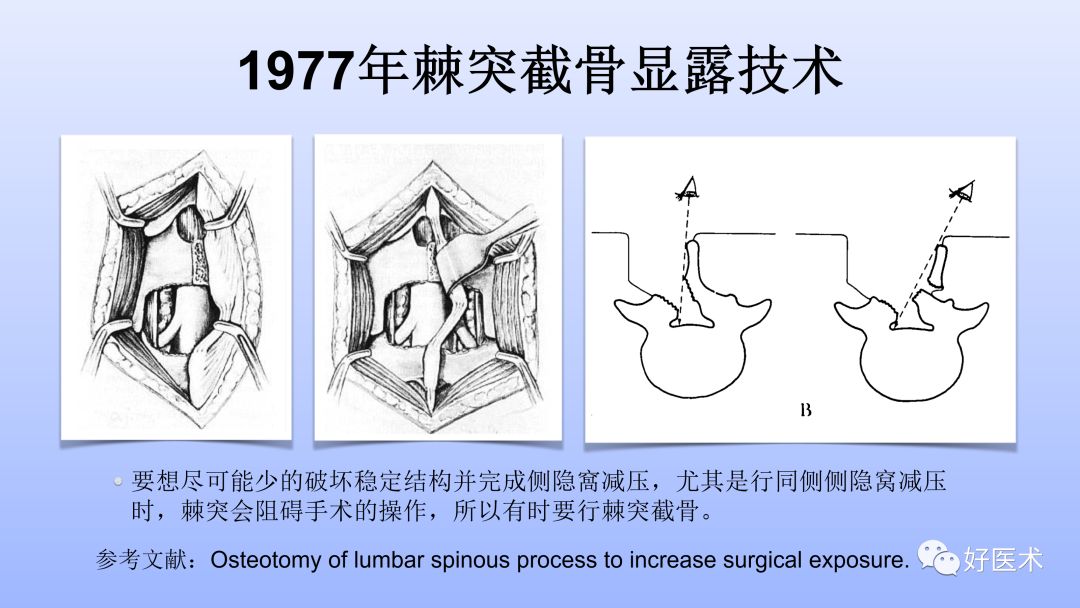 一文带您深度了解：腰椎管狭窄症！