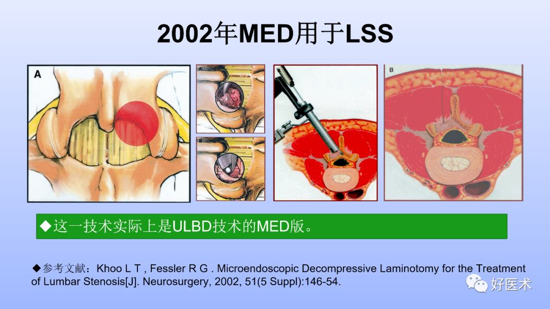 一文带您深度了解：腰椎管狭窄症！