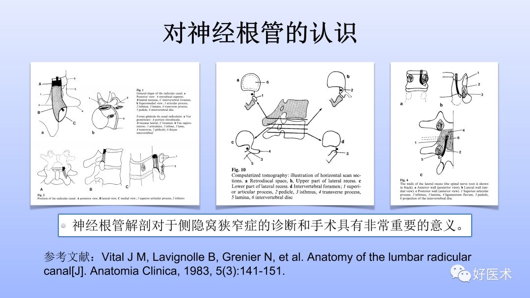 一文带您深度了解：腰椎管狭窄症！