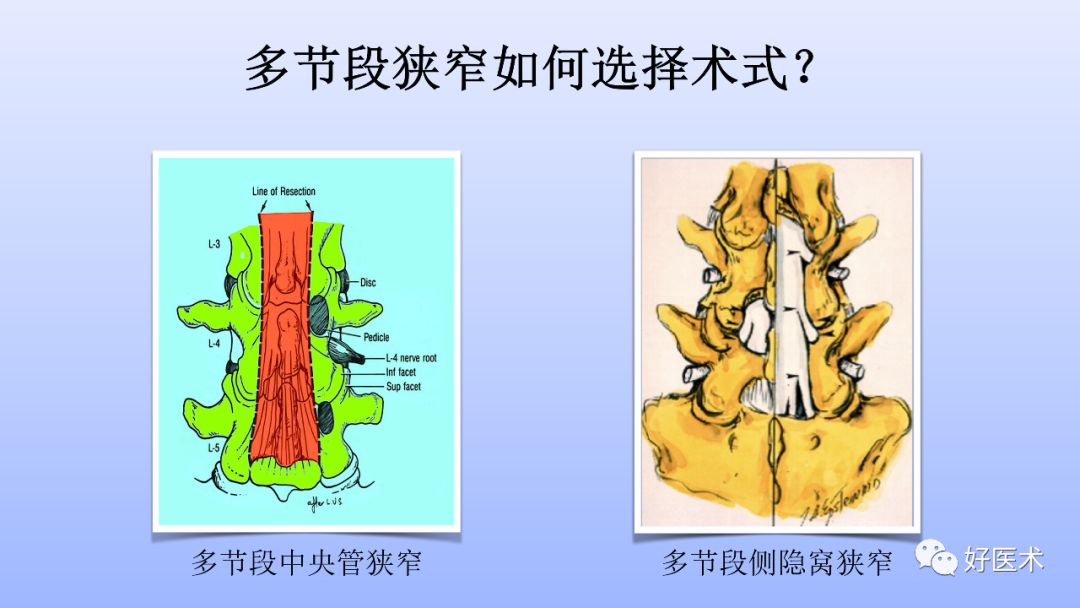 一文带您深度了解：腰椎管狭窄症！