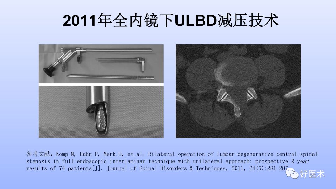 一文带您深度了解：腰椎管狭窄症！