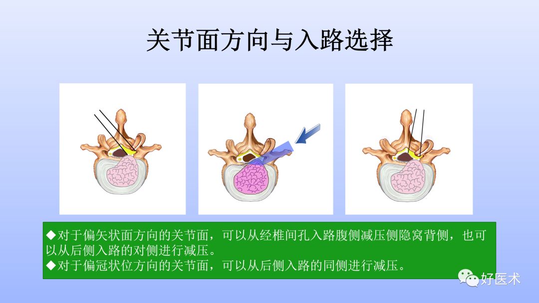 一文带您深度了解：腰椎管狭窄症！