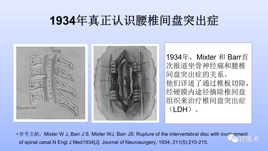 一文带您深度了解：腰椎管狭窄症！