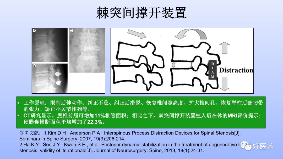 一文带您深度了解：腰椎管狭窄症！