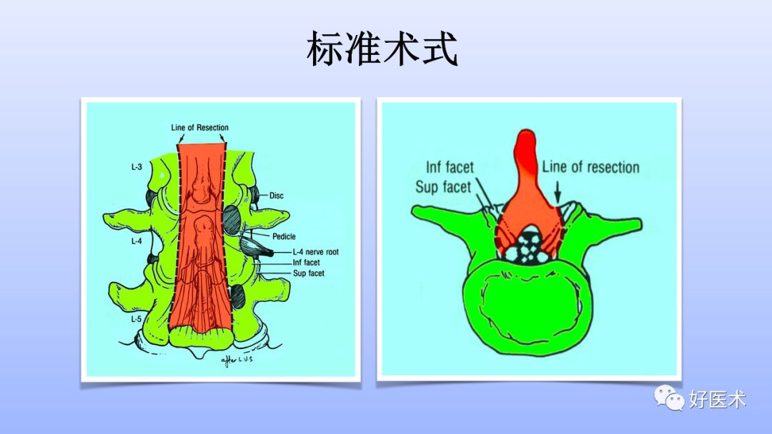 一文带您深度了解：腰椎管狭窄症！