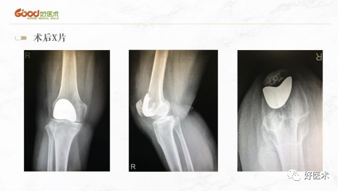 微创治疗膝骨关节炎，技巧要点全解析！