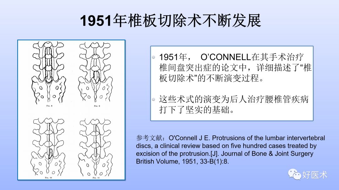 一文带您深度了解：腰椎管狭窄症！