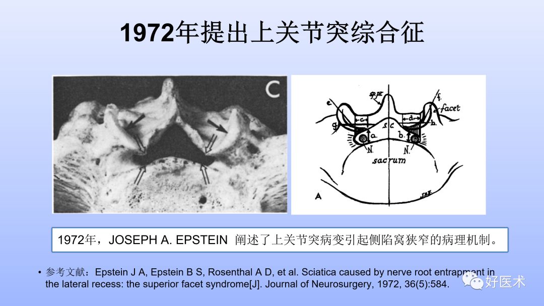 一文带您深度了解：腰椎管狭窄症！