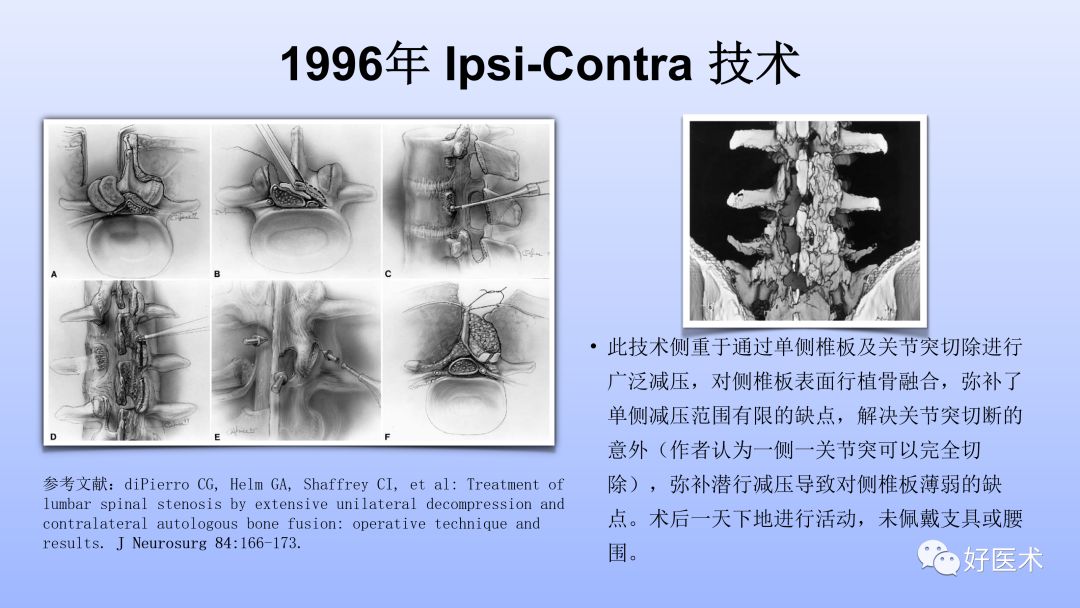 一文带您深度了解：腰椎管狭窄症！