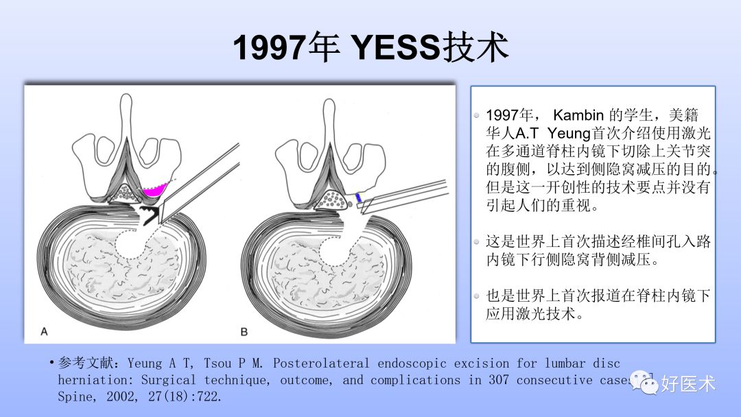 一文带您深度了解：腰椎管狭窄症！