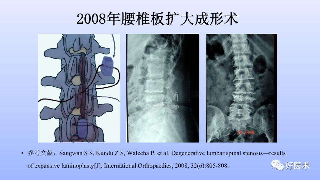 一文带您深度了解：腰椎管狭窄症！