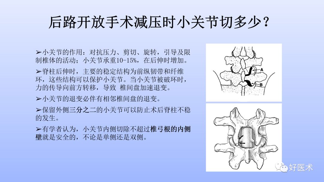 一文带您深度了解：腰椎管狭窄症！