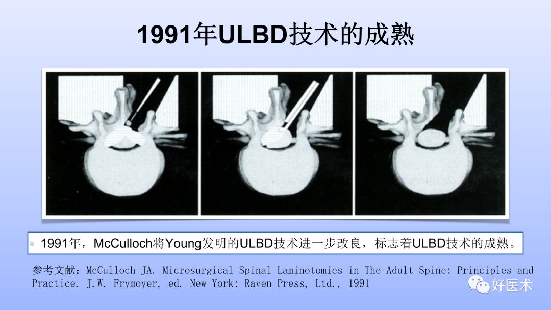 一文带您深度了解：腰椎管狭窄症！