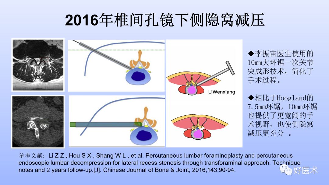 一文带您深度了解：腰椎管狭窄症！