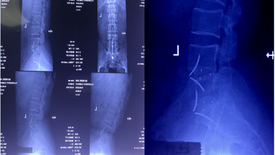 腰椎手术失败：原因探讨及处理技巧大起底（内附经典案例）！