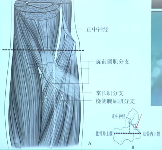 冠状突骨折如何精准确定入路？详细介绍在这！