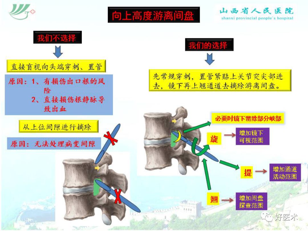 椎间孔镜治疗特殊类型腰椎间盘突出症，要点详解！