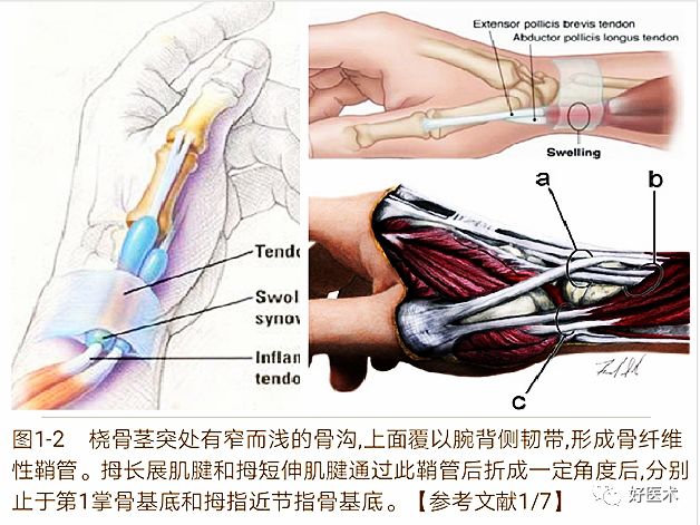 手腕部狭窄性腱鞘炎的诊治，一文掌握！