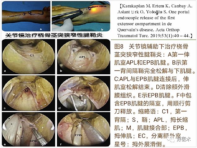 手腕部狭窄性腱鞘炎的诊治，一文掌握！