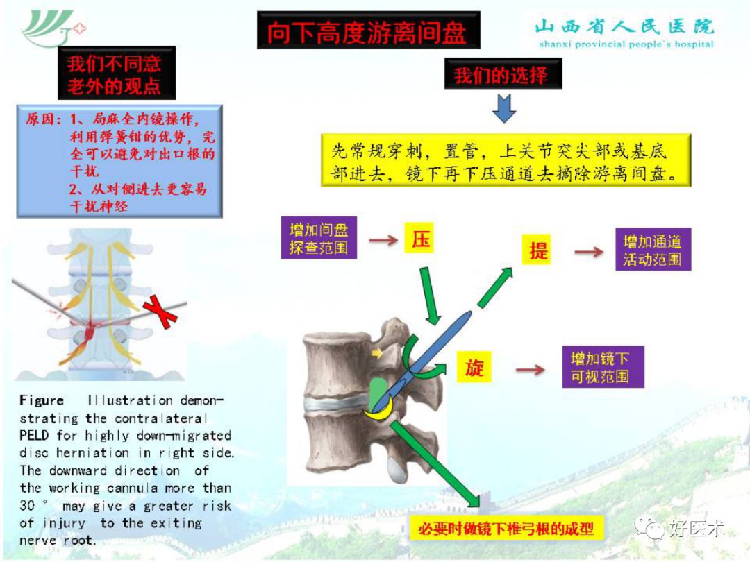 椎间孔镜治疗特殊类型腰椎间盘突出症，要点详解！