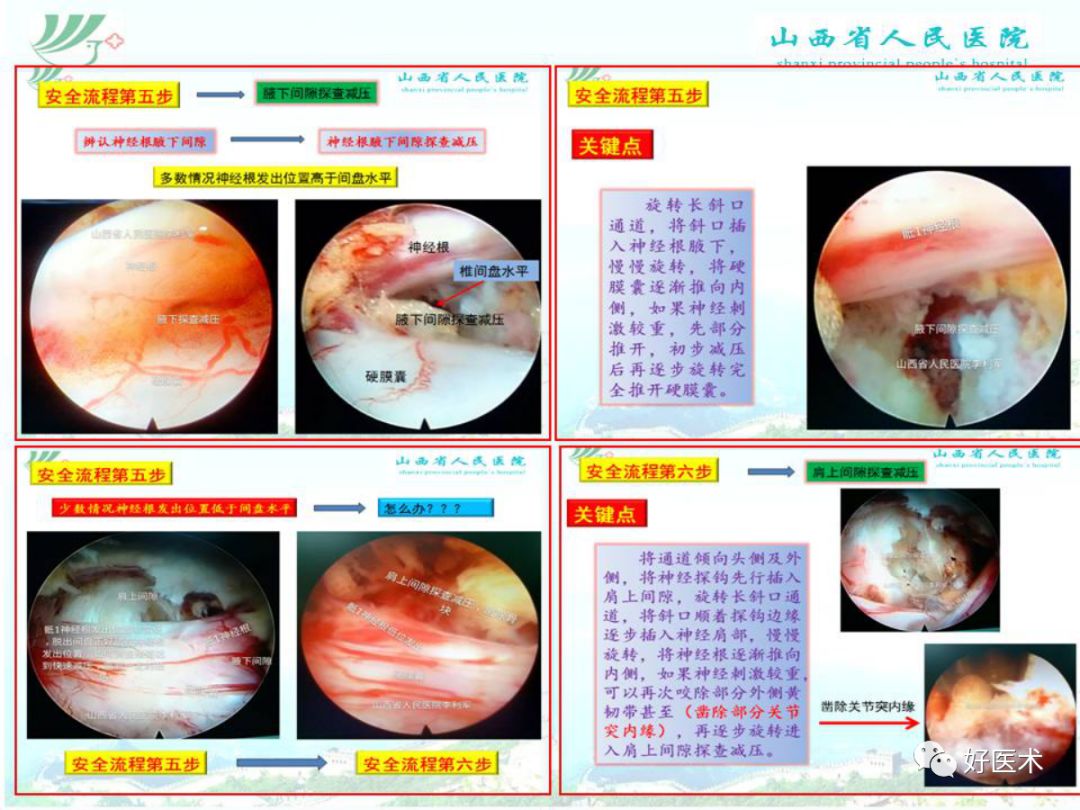 椎间孔镜治疗特殊类型腰椎间盘突出症，要点详解！