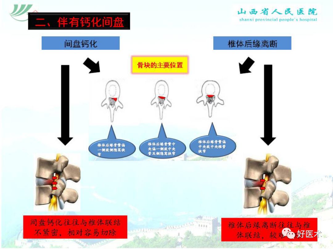 椎间孔镜治疗特殊类型腰椎间盘突出症，要点详解！