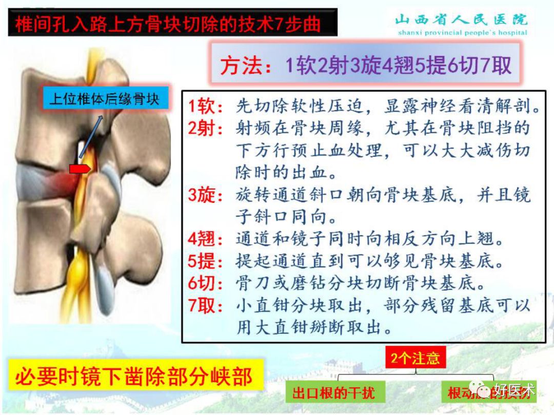 椎间孔镜治疗特殊类型腰椎间盘突出症，要点详解！