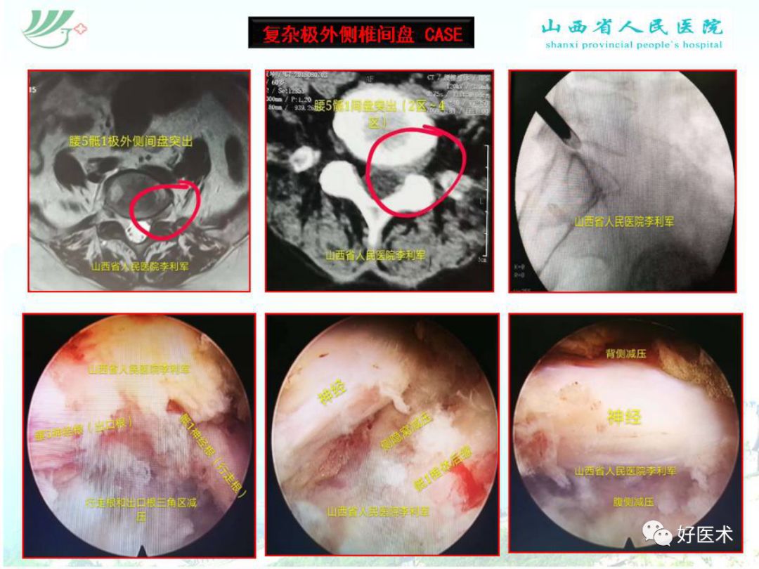 椎间孔镜治疗特殊类型腰椎间盘突出症，要点详解！