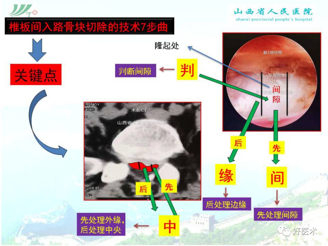 椎间孔镜治疗特殊类型腰椎间盘突出症，要点详解！