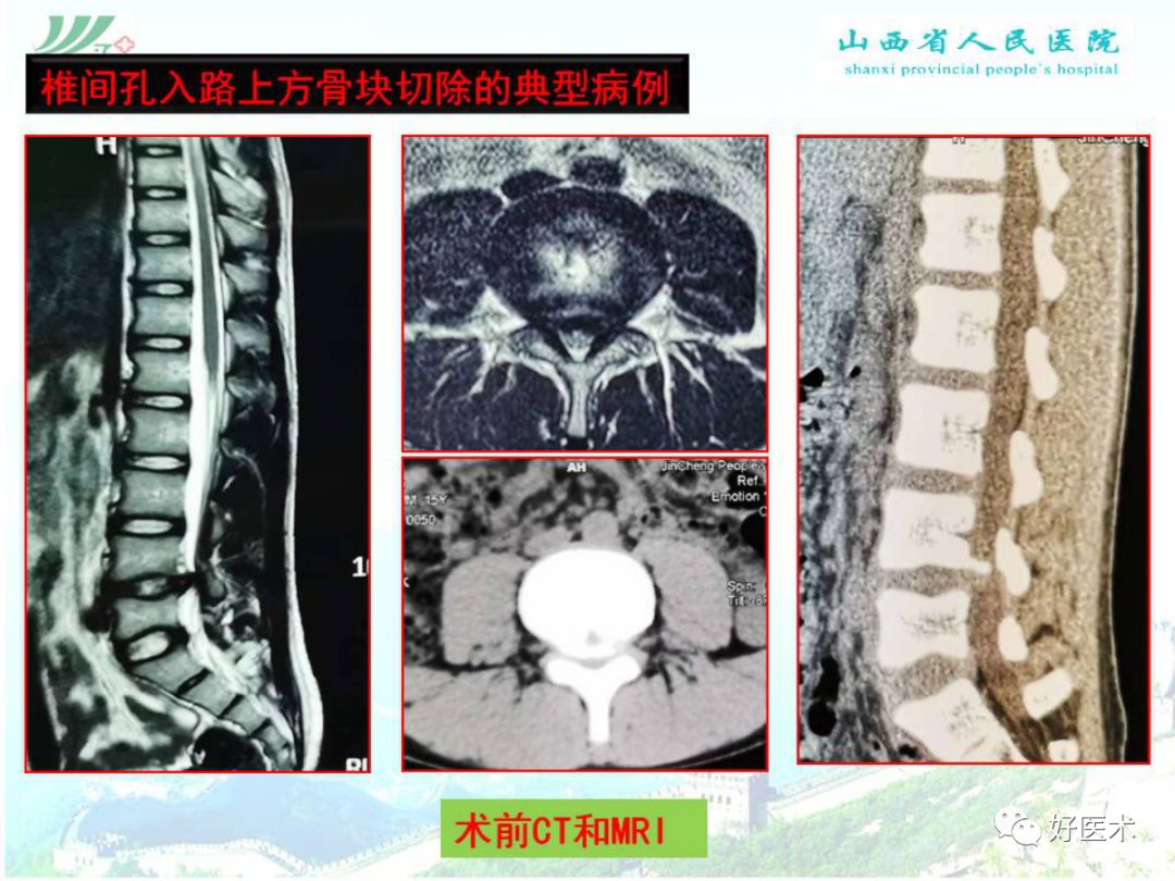 椎间孔镜治疗特殊类型腰椎间盘突出症，要点详解！