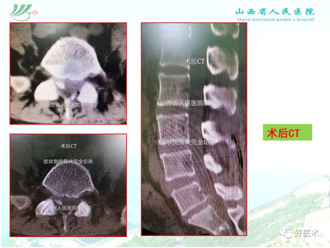 椎间孔镜治疗特殊类型腰椎间盘突出症，要点详解！