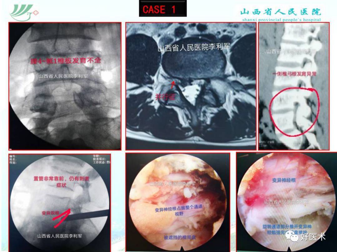 椎间孔镜治疗特殊类型腰椎间盘突出症，要点详解！