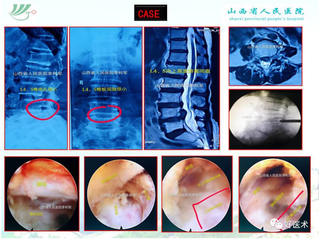 椎间孔镜治疗特殊类型腰椎间盘突出症，要点详解！