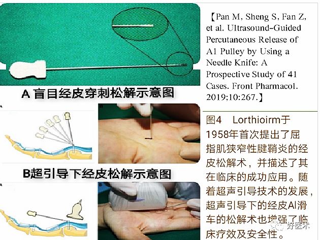 手腕部狭窄性腱鞘炎的诊治，一文掌握！