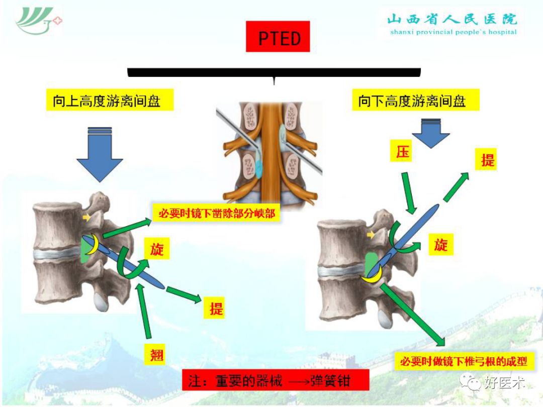 椎间孔镜治疗特殊类型腰椎间盘突出症，要点详解！